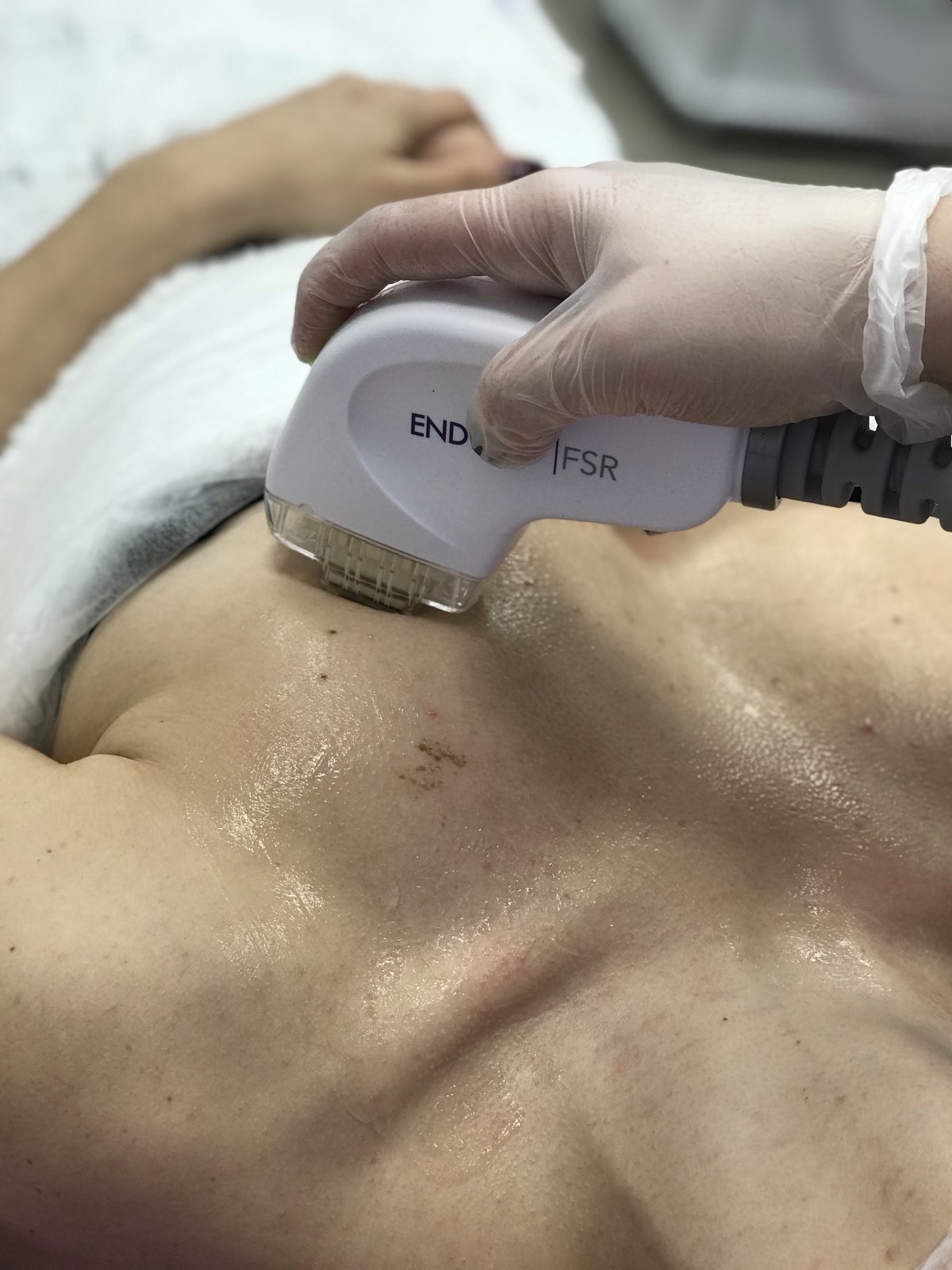 Фракційне шліфування шкіри обличчя та тіла на апараті EndyMed